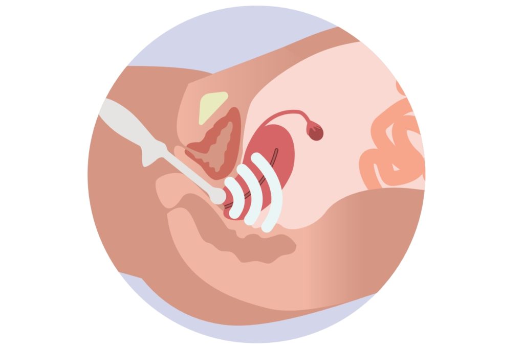 A graphic depicting a transvaginal ultrasound to show diagnosis of adenomyosis.