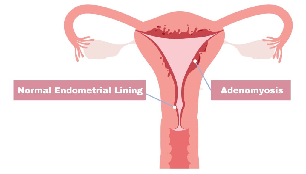 A graphic of a uterus, with illustrations showing the difference between normal endometrial lining and adenomyosis.