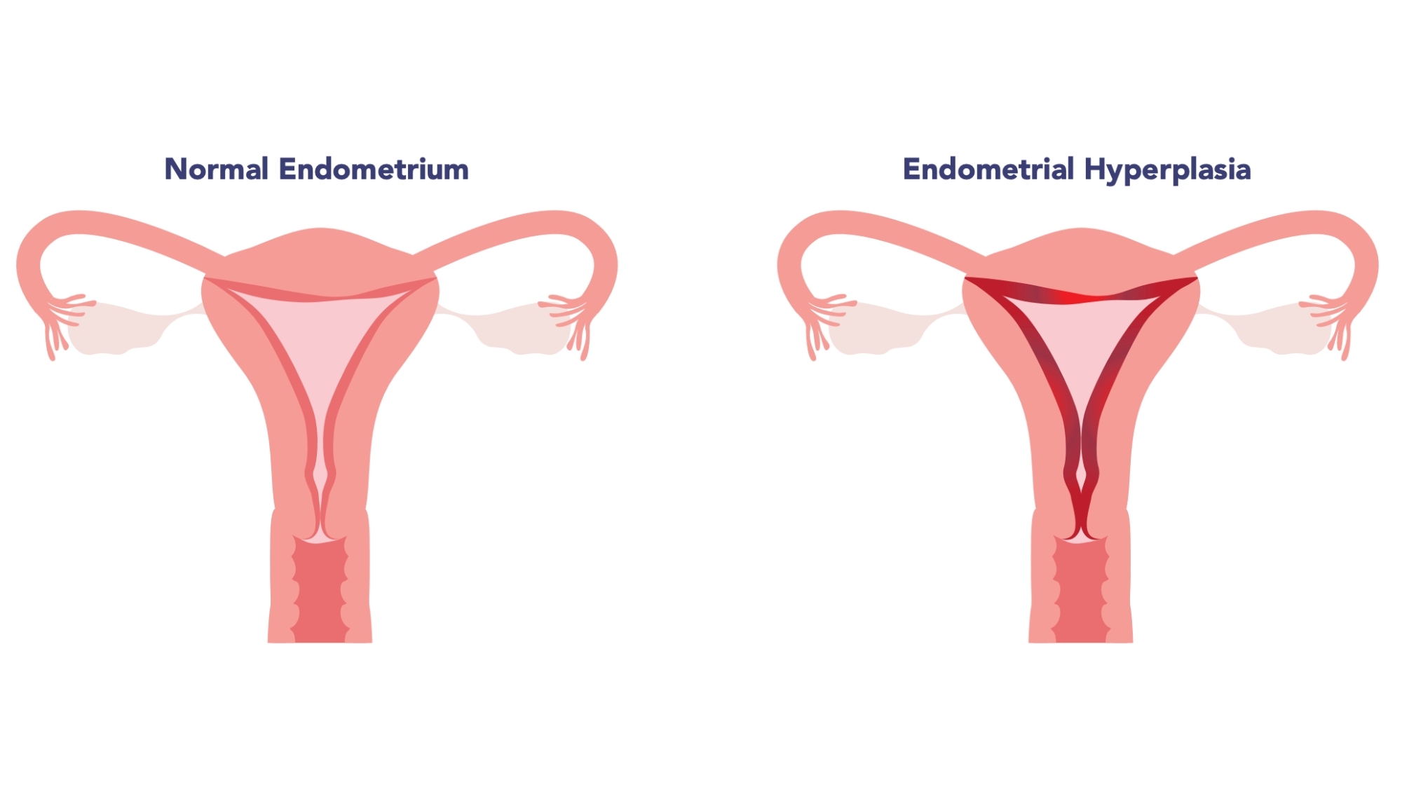 Endometrial Hyperplasia - Information, Evaluation, and Treatment