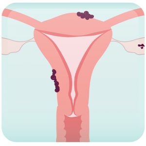 Endometriosis General Information