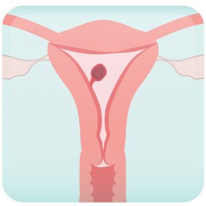 Endometriosis Polys