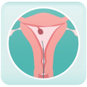 Endometriosis Polys Evaluation