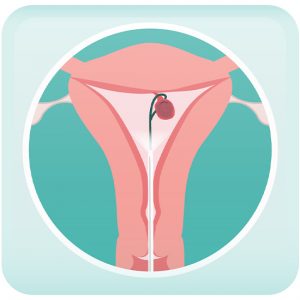Endometrial Polys Treatment