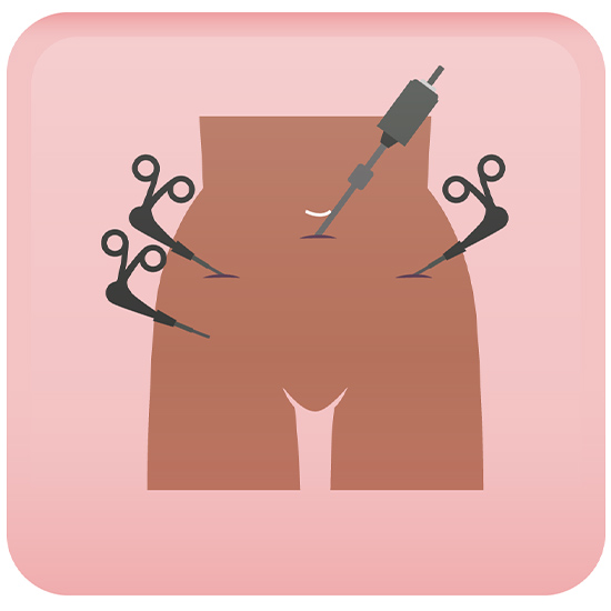 Routes of Hysterectomy