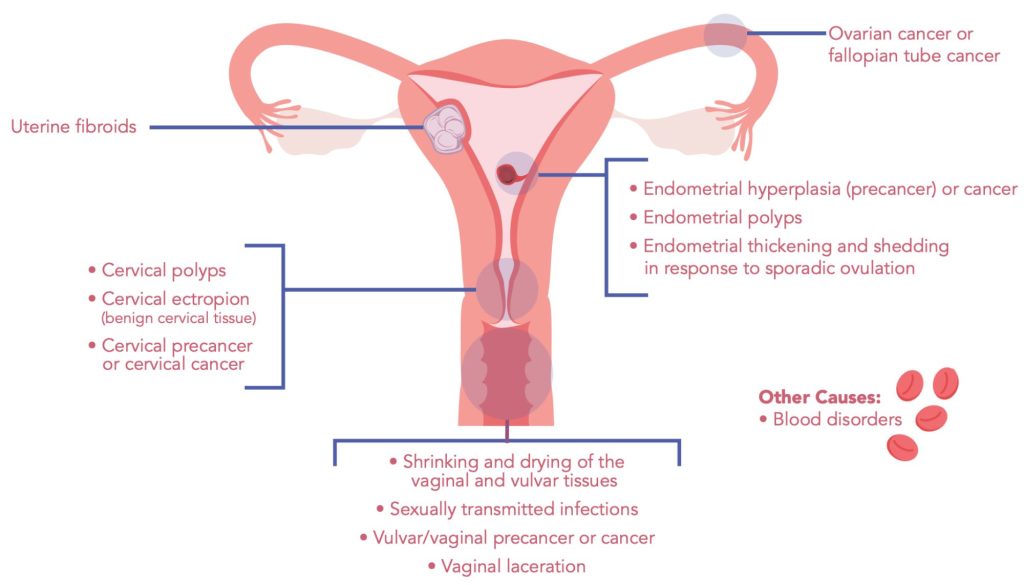 A graphic showing the reproductive system showing ovarian cancer, fibroids, cervical causes of bleeding, endometrial causes of bleeding and vaginal causes of bleeding.