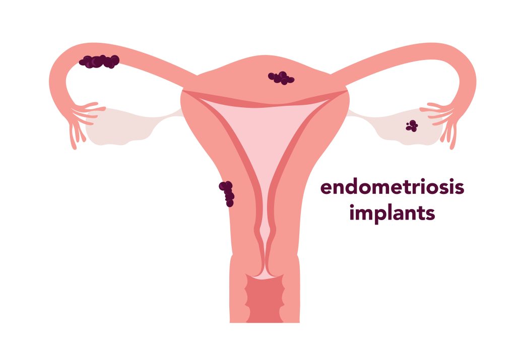 Illustration of internal female reproductive organs with Endometriosis implants