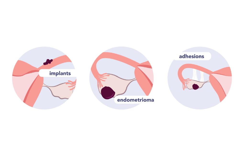 Close up illustrations of endometriosis implants, endometrioma and adhesions