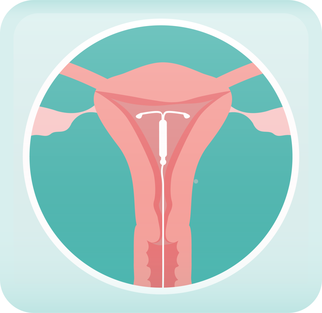 illustration of an IUD in a uterus