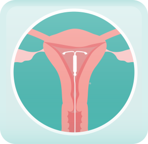 illustration of an IUD in a uterus