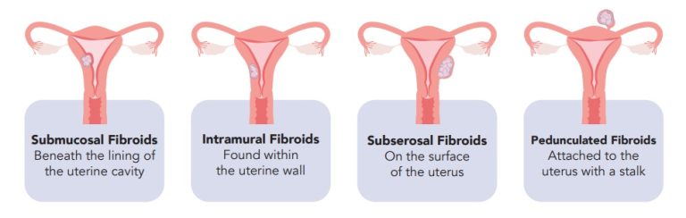 Fibroid Portal - Gynaecology Collaboration