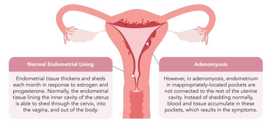 Adenomyosis can be Responsible for Heavy Vaginal Bleeding and Pain During a  Menstruation Cycle, Best Uro-Gynecologist Los Angeles, OB/GYN Glendale