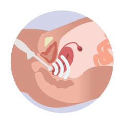 adenomyosis