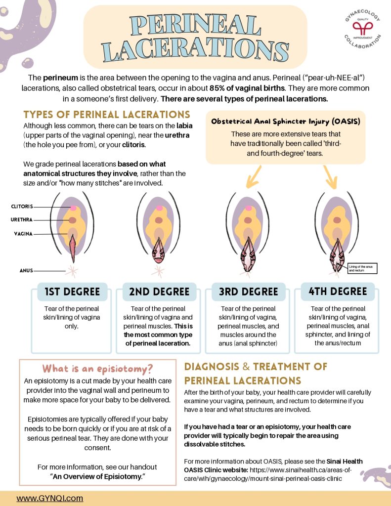 Perineal Lacerations Handout Image 1